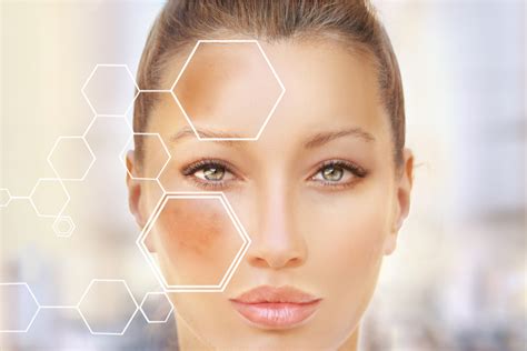 Hyperpigmentation Types Causes Treatments And Prevention