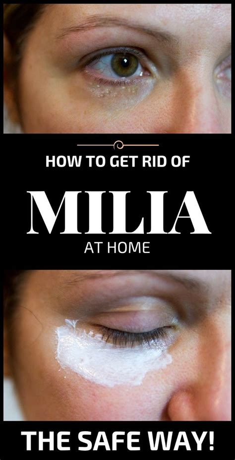 How To Get Rid Of Milia At Home Easily Skin Bumps Skin Spots Bumps