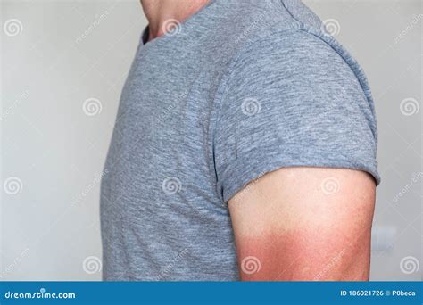 Sunburned Hand Stock Photo Image Of Painful Damage 186021726