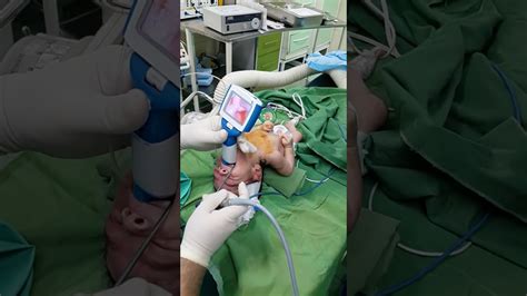 Newborn Intubation Using Ue Miller 0 Blade Youtube