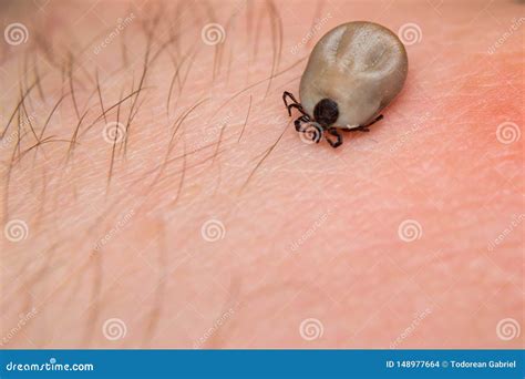 Tick On Human Leg Dangerous Parasite On Human Skin Stock Photo