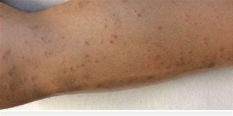 An Erythematous Non Pruritic Maculopapular Rash Scattered Diffusely On