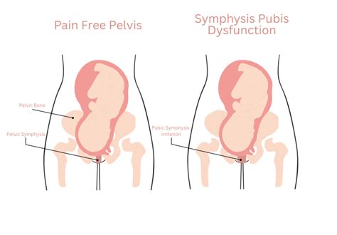 Pelvic Pain During Pregnancy Pelvic Pain Foundation