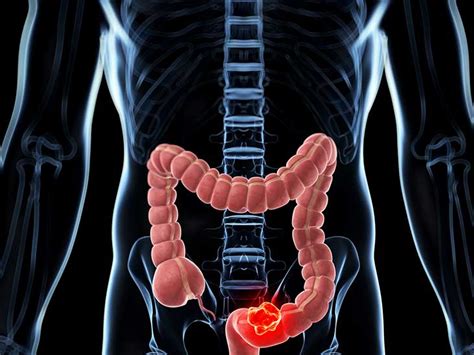 Colorectal cancer (colon cancer) is the cause of many cancer deaths. Colonic (Colorectal) Polyps: Causes, Symptoms, and Diagnosis