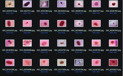 14 Skin Lesion Classifier Dataset Of Casd System For Memory Storage In