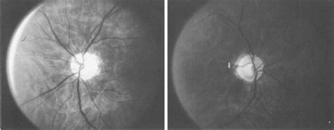 Optic Neuropathy And Amiodarone Therapy Mayo Clinic Proceedings