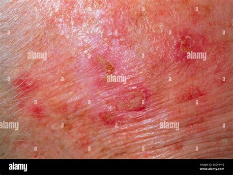 Solar Keratosis Close Up Of A Patients Skin Showing Solar Keratosis