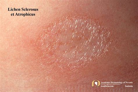 Lichen Sclerosus Lichen Sclerosus Et Atrophicus Kraurosis Vulvae