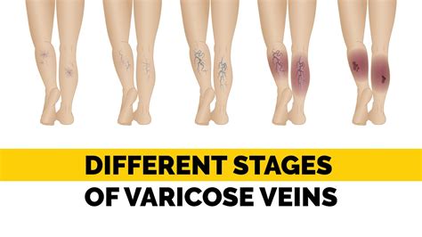 What Are Varicose Veins Different Stages Of Varicose Veins For