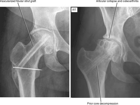 Assessment of traumatic brain injury online course: IMAGING OF THE HIP AND PELVIS | Radiology Key