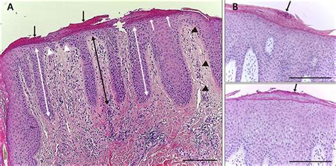 Increased Expression Of Interleukin 12 In Lesional Skin Of Atopic