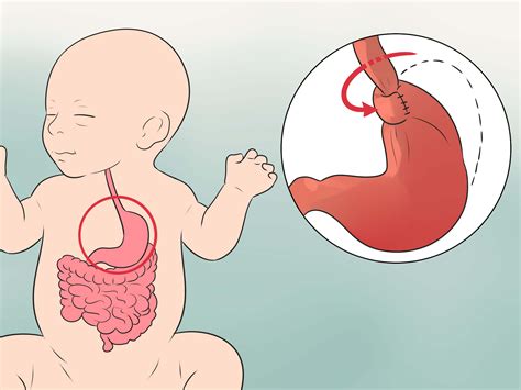 How To Treat Acid Reflux In Newborns 11 Steps With Pictures