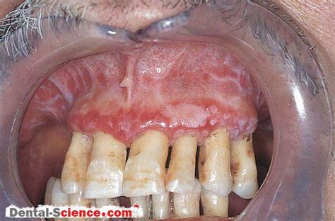 Oral Lichen Planus Dental Science
