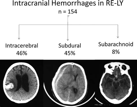 Intracranial Hemorrhage In Atrial Fibrillation Patients During
