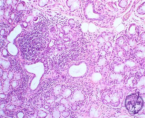Oral Salivary Gland Sj Gren S Syndrome Pathology Core Pictures