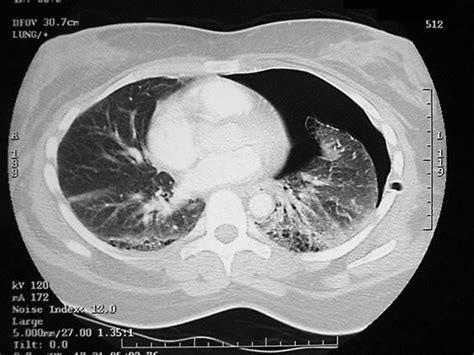 Pneumothorax Definition Causes And Treatment Britannica