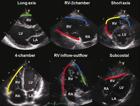 Current And Future Role Of Echocardiography In Arrhythmogenic Right