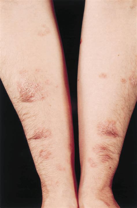 Plaques Of Psoriasis On The Forearm Coarse Dark Hairs Can Be Seen