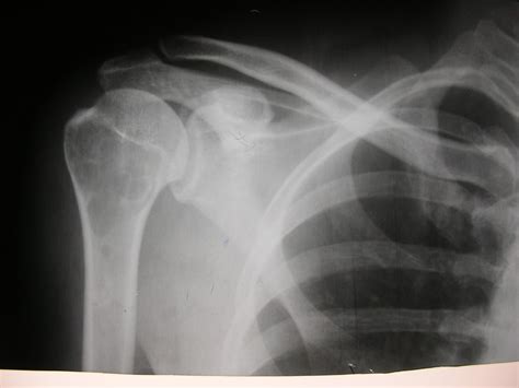 X Rays And Slides Simple Bone Cyst In The Proximal Humerus