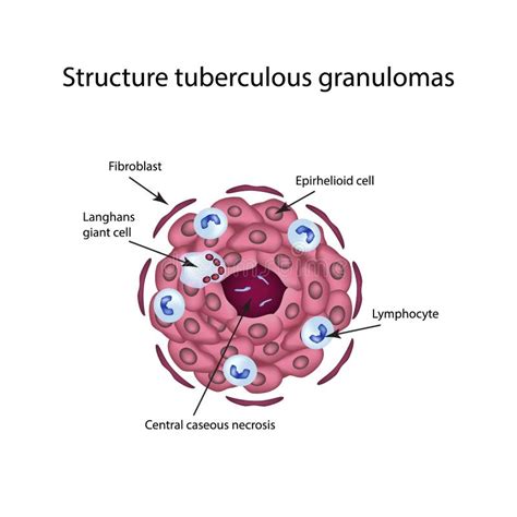 The Structure Of Tuberculous Granulomas Vector Illustration On