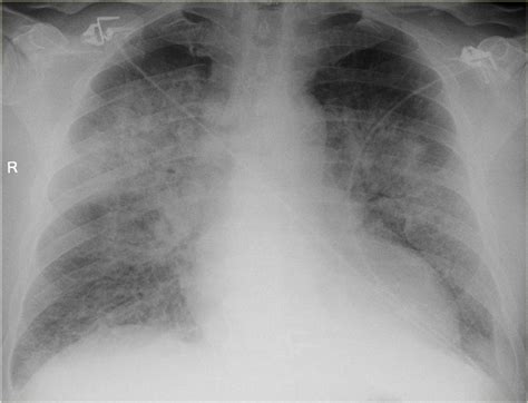 Condition Specific Radiology Alveolar Pulmonary Edema Stepwards