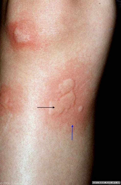 Chronic Urticaria Is Defined By Symptoms Lasting For More Than Six