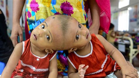 What Life Is Really Like As A Conjoined Twin
