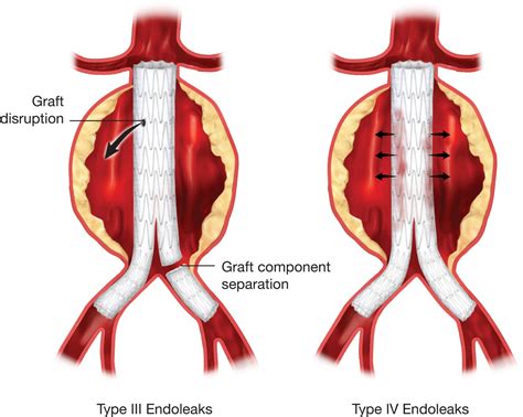 Duplex Assessment Of Aortic Endografts Thoracic Key