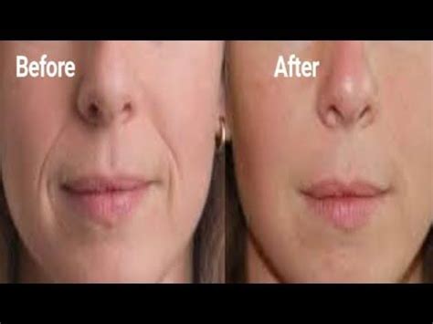 Best Treatment For Deep Wrinkles On Cheeks