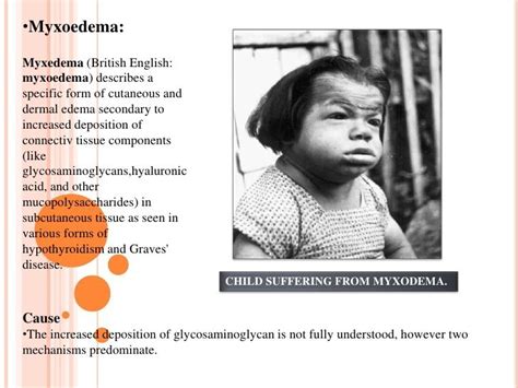 Fizionomia Unui Copil Care Sufera De O Boala Endocrina