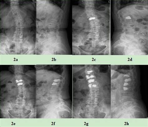 Association Between Degenerative Scoliosis And Re Fracture A