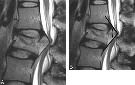 Dural Tears In Spinal Burst Fractures Predictable Mr Imaging Findings