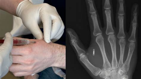 Wisconsin Company Is Injecting Rfid Microchips Into Hands Of Employees