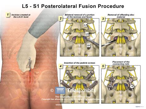 L5 S1 Posterolateral Fusion Procedure Trialexhibits Inc