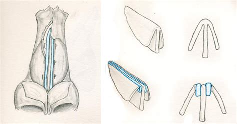 Saddle Nose Deformity Rhinoplasty Archive