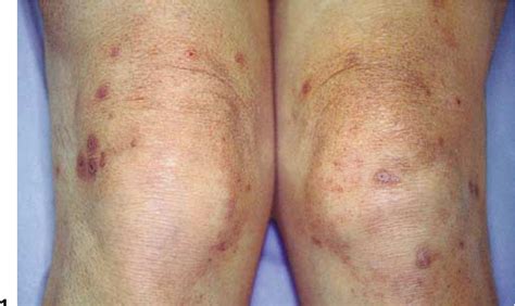 Figure 1 From Acquired Perforating Dermatosis In A Patient With Poland