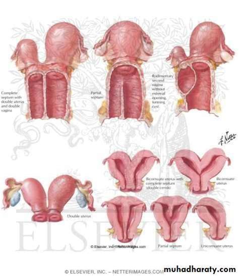 Abnormal development of Female genital tract pptx د براء Muhadharaty