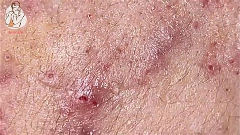 Inflamed Acne Under Skin Blackhead Extraction Blackhead Removal 0134