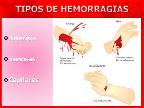 Tipos De Hemorragias Como Actuar Hemorragia Hemorragia Primeros Images