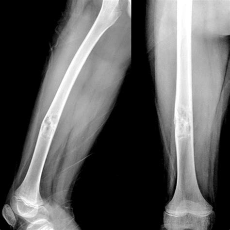 Anteroposterior And Lateral Radiograph Showing A Located Lytic Lesion