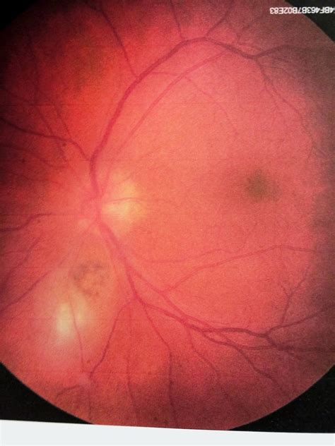 Diagnose My Retinal Photograph Inflammatory Retinal Disease Edition