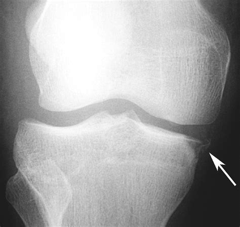 Avulsion Fractures Of The Knee Imaging Findings And Clinical