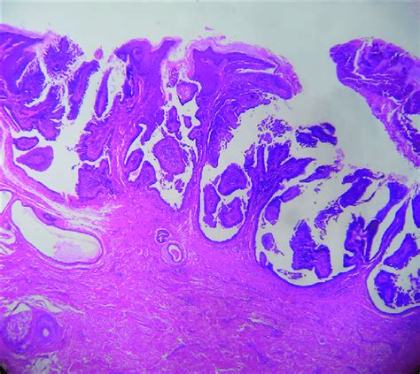 Photomicrograph Showing Hyperkeratosis Acanthosis Papillomatosis And