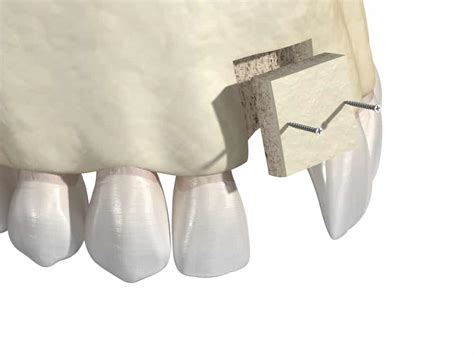 A Guide To Bone Grafts For Dental Implants