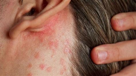 Skin Rashes By Anxiety Build Your Body