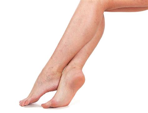 An Overview Of Leg Discoloration And Preventive Measures