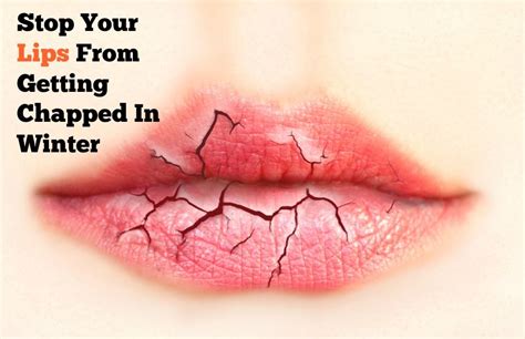 Stop Your Lips Getting Chapped In Winter With These Awesome Home