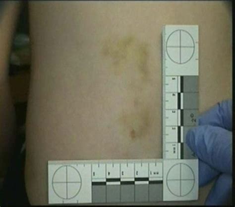 Bruises And Fractures When Is It Child Abuse Godoy Medical Forensics