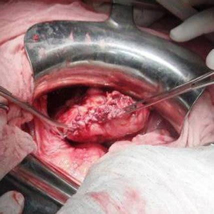 La péritonite est une inflammation aiguë du péritoine, la membrane qui recouvre les organes de la cavité abdominale. (PDF) Cas clinique: Peritonite aigue par rupture non ...