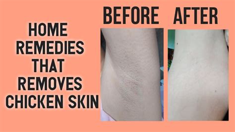 How To Remove Chicken Skin In Just A Week Home Remedies Chicken Skin